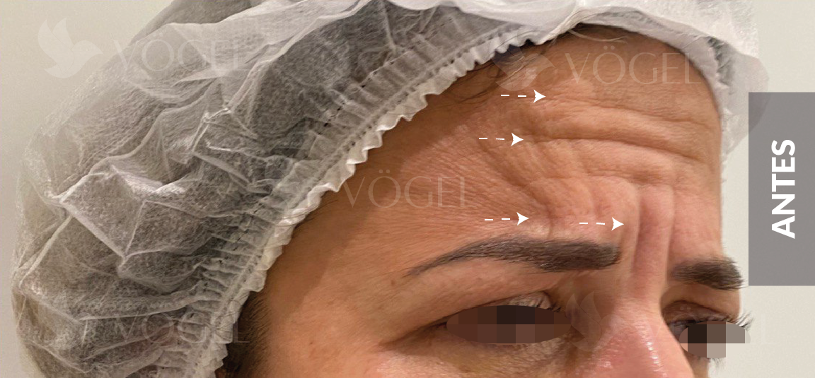 AntesDepois (39)